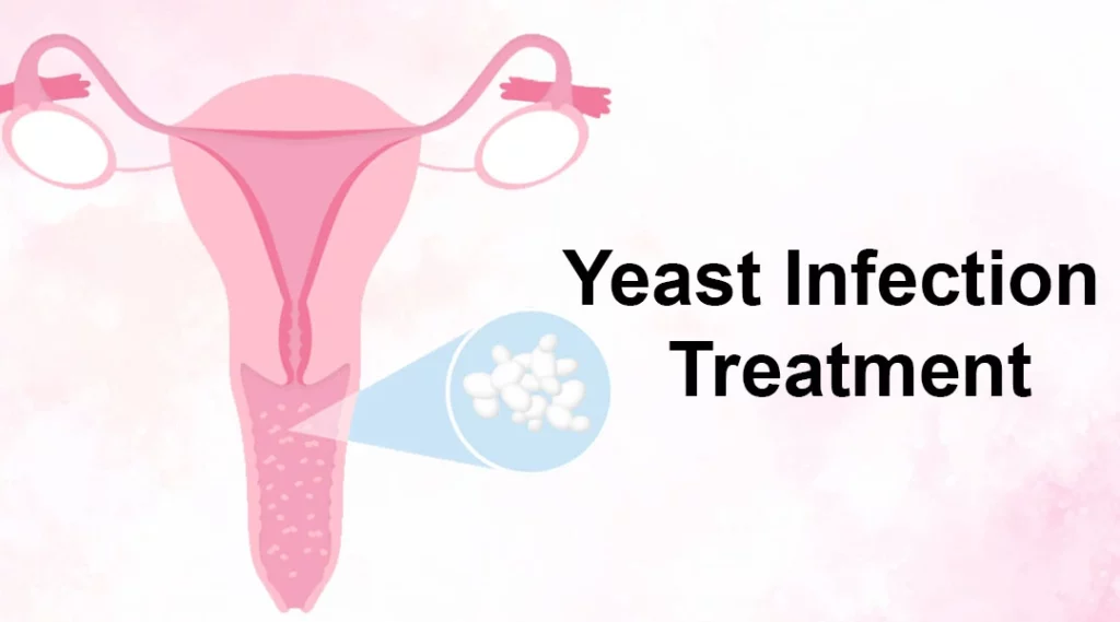 Yeast Infection