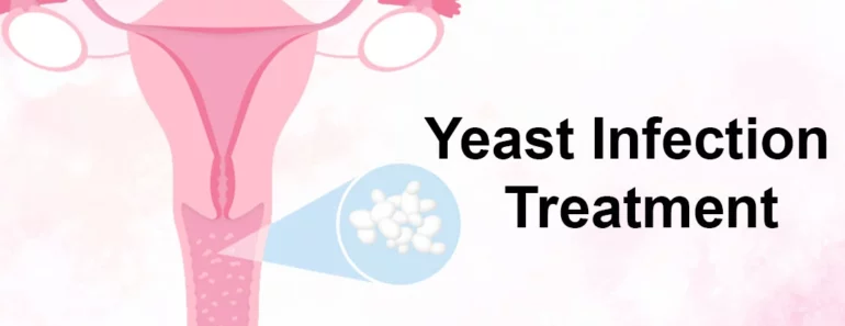 How to Get Rid of a Yeast Infection in 24 Hours